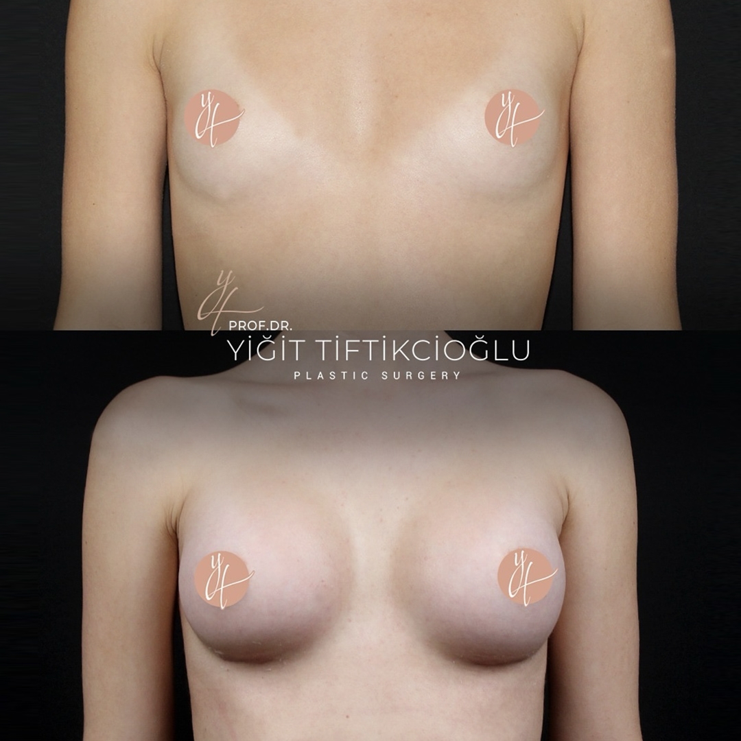 Breast Augmentation in Turkey (Breast Implant)