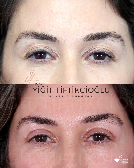 Blepharoplasty Before and After in Turkey