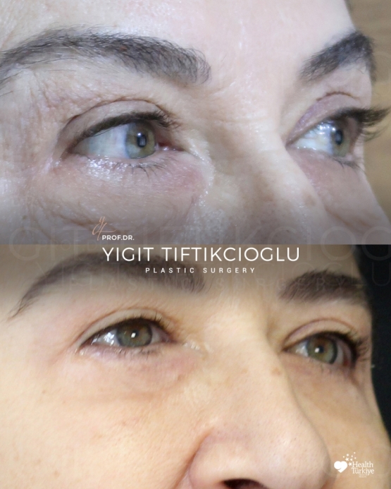 Blepharoplasty Before and After in Turkey