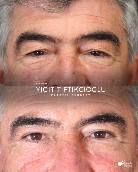 Blepharoplasty Before and After in Turkey