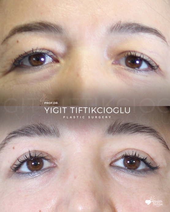Blepharoplasty Before and After in Turkey