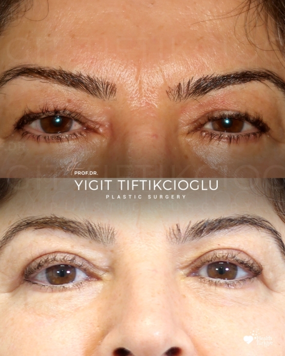 Blepharoplasty Before and After in Turkey
