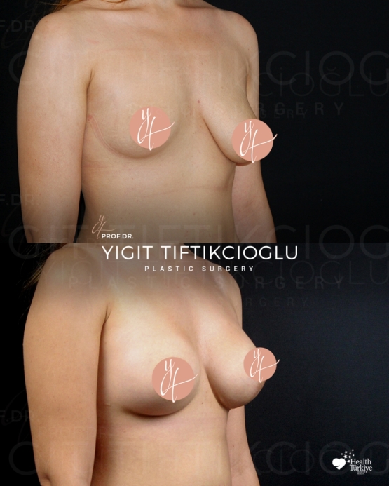 Breast Asymmetry Correction Before and After
