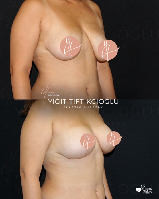Breast Lift (Mastopexy) Before and After