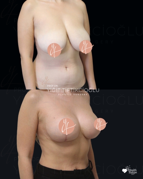 Breast Lift (Mastopexy) Before and After