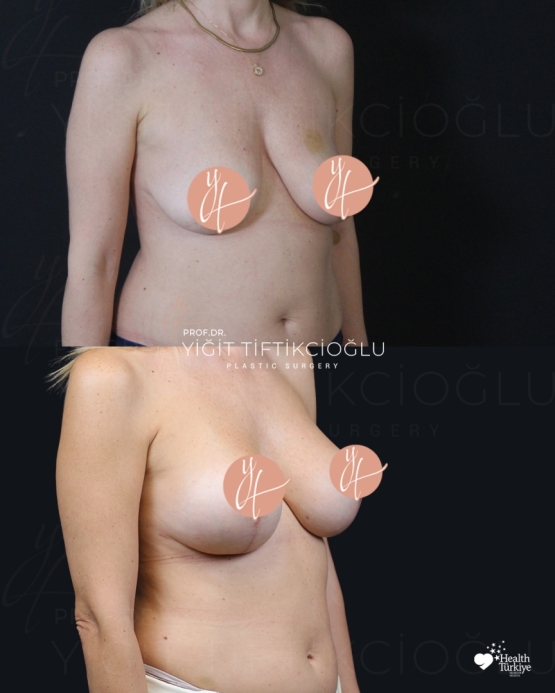Breast Lift (Mastopexy) Before and After