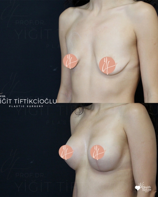 Breast Lift (Mastopexy) Before and After