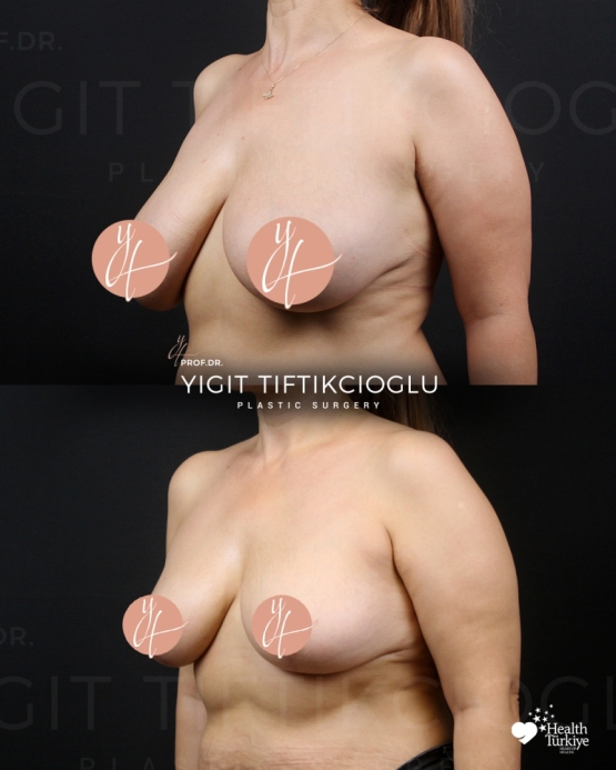Breast Reduction Before and After in Izmir, Turkey