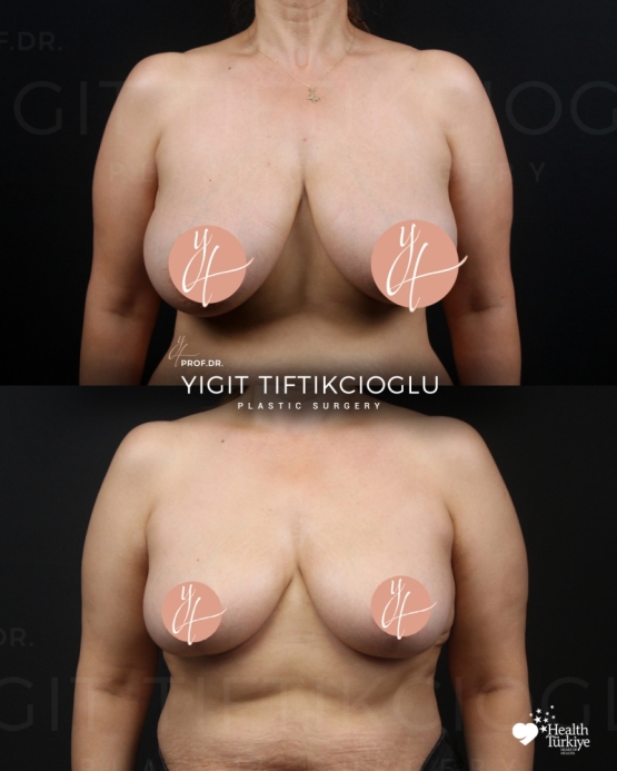 Breast Reduction Before and After in Izmir, Turkey