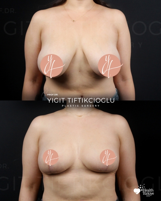 Breast Reduction Before and After in Izmir, Turkey