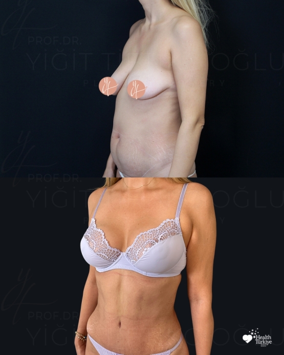 Mommy Makeover Before and After Turkey