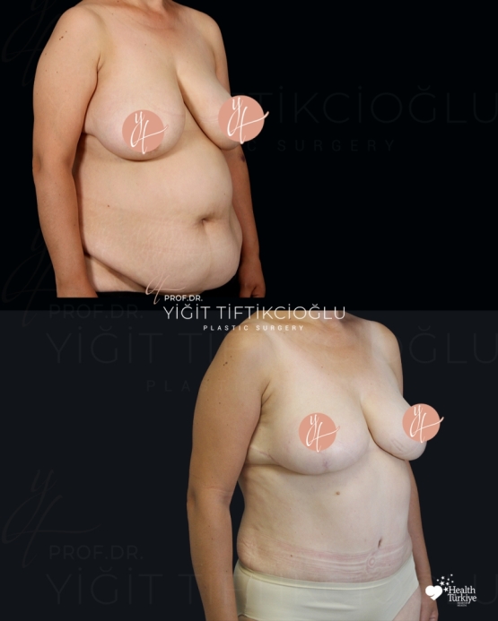 Mommy Makeover Before and After Turkey