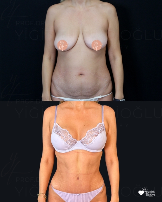 Mommy Makeover Before and After Turkey