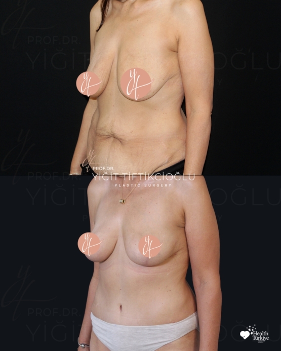 Mommy Makeover Before and After Turkey