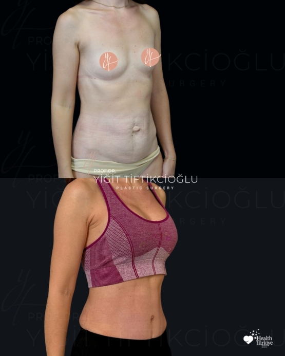 Mommy Makeover Before and After Turkey