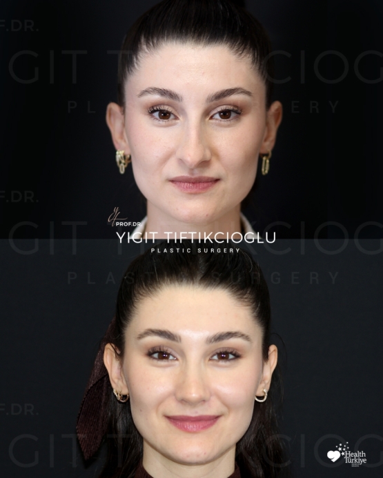 Rhinoplasty Turkey Before and After