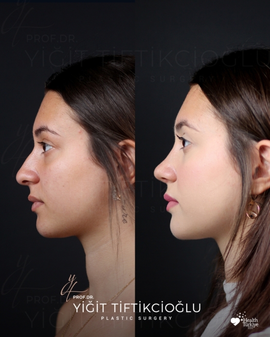Rhinoplasty Turkey Before and After