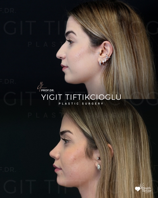 Rhinoplasty Turkey Before and After
