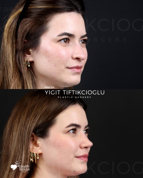 Rhinoplasty Turkey Before and After