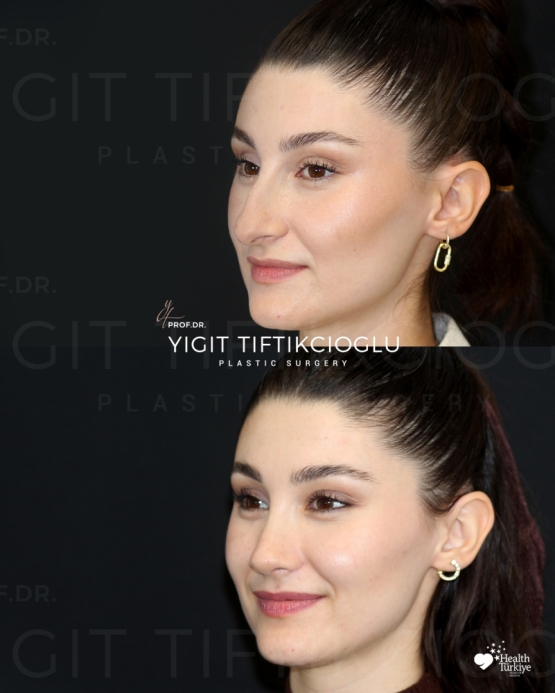 Rhinoplasty Turkey Before and After