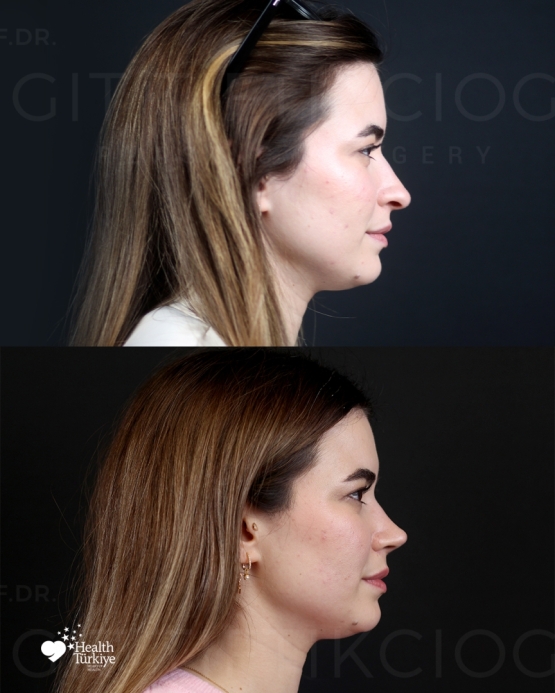 Rhinoplasty Turkey Before and After