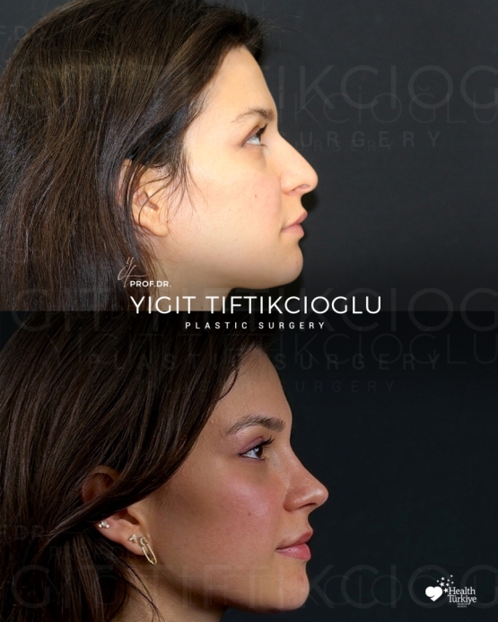 Rhinoplasty Turkey Before and After
