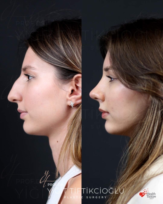 Rhinoplasty Turkey Before and After