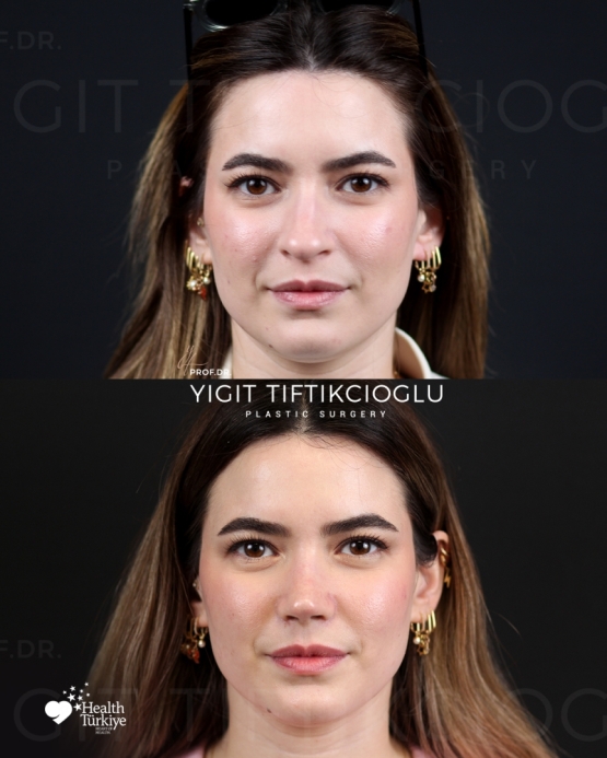 Rhinoplasty Turkey Before and After