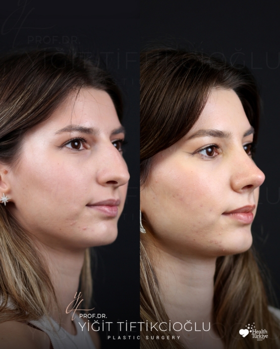 Rhinoplasty Turkey Before and After