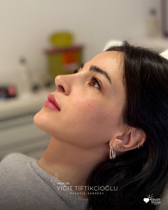 Rhinoplasty Turkey Before and After