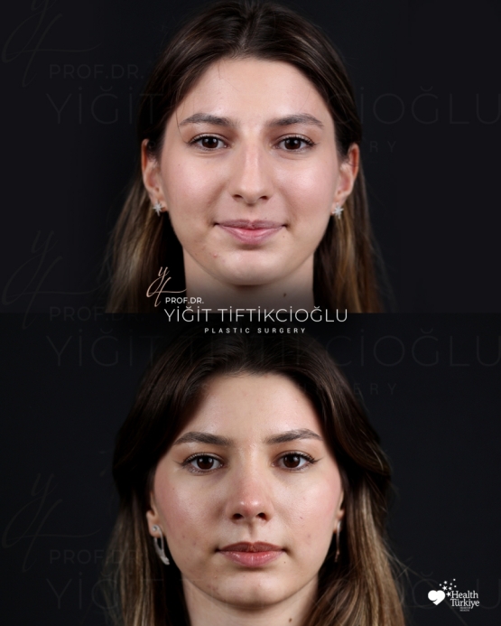 Rhinoplasty Turkey Before and After