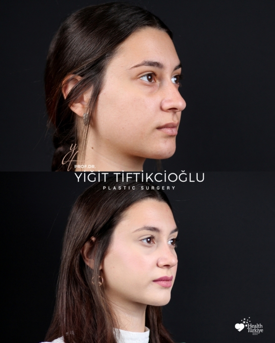 Rhinoplasty Turkey Before and After