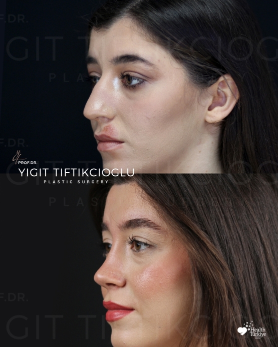 Rhinoplasty Turkey Before and After