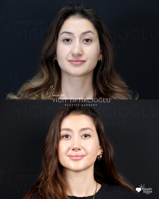 Secondary Rhinoplasty (Revision) Before and After