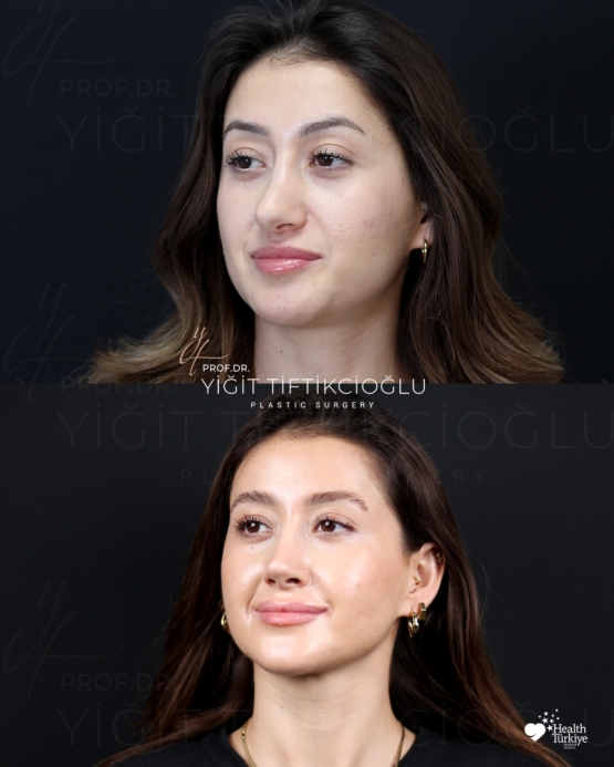 Secondary Rhinoplasty (Revision) Before and After