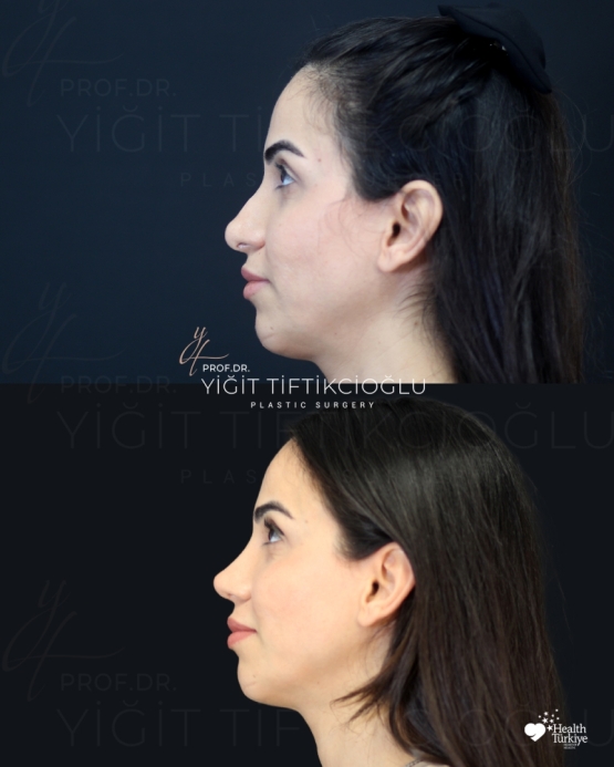 Secondary Rhinoplasty (Revision) Before and After