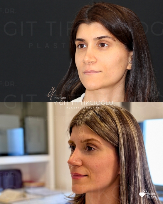 Secondary Rhinoplasty (Revision) Before and After