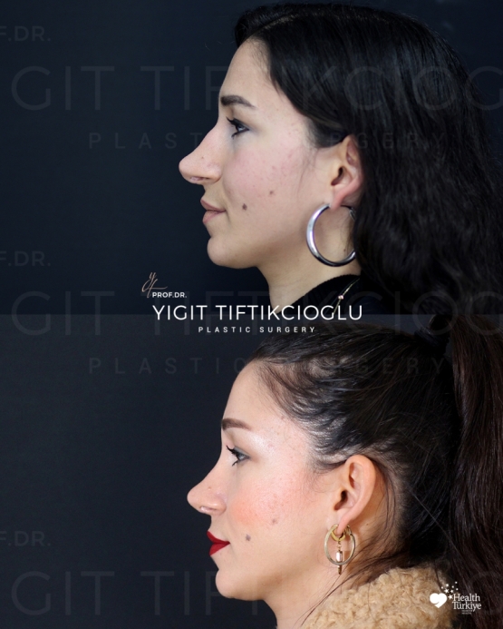Secondary Rhinoplasty (Revision) Before and After