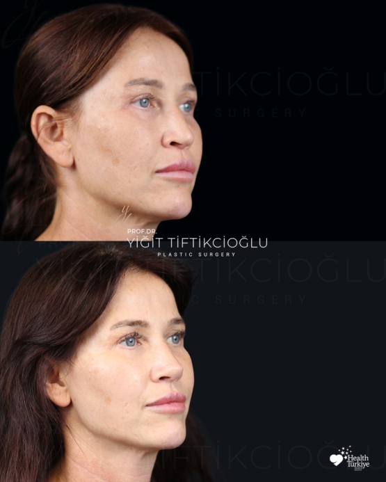 Secondary Rhinoplasty (Revision) Before and After