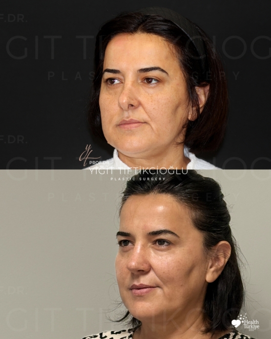Secondary Rhinoplasty (Revision) Before and After