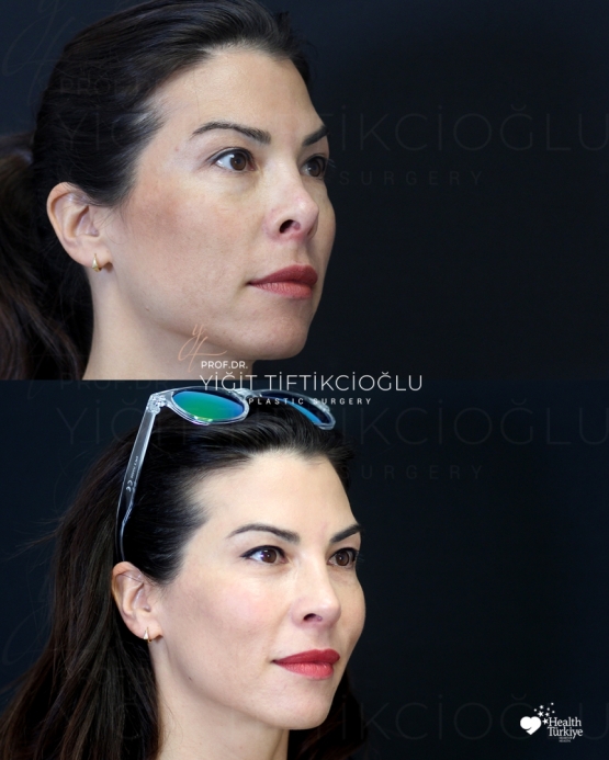 Secondary Rhinoplasty (Revision) Before and After