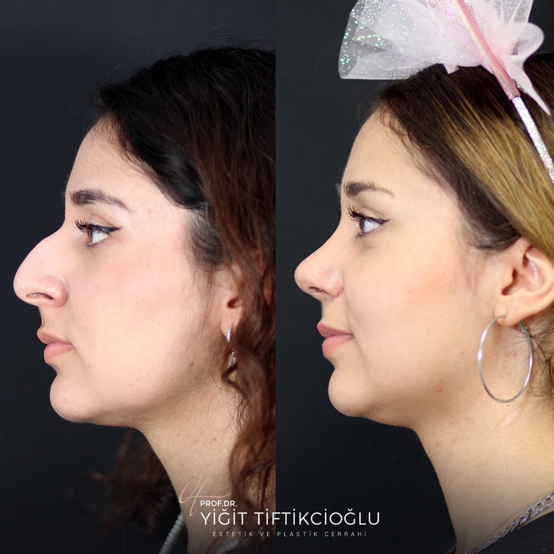 Rhinoplasty Turkey Before and After