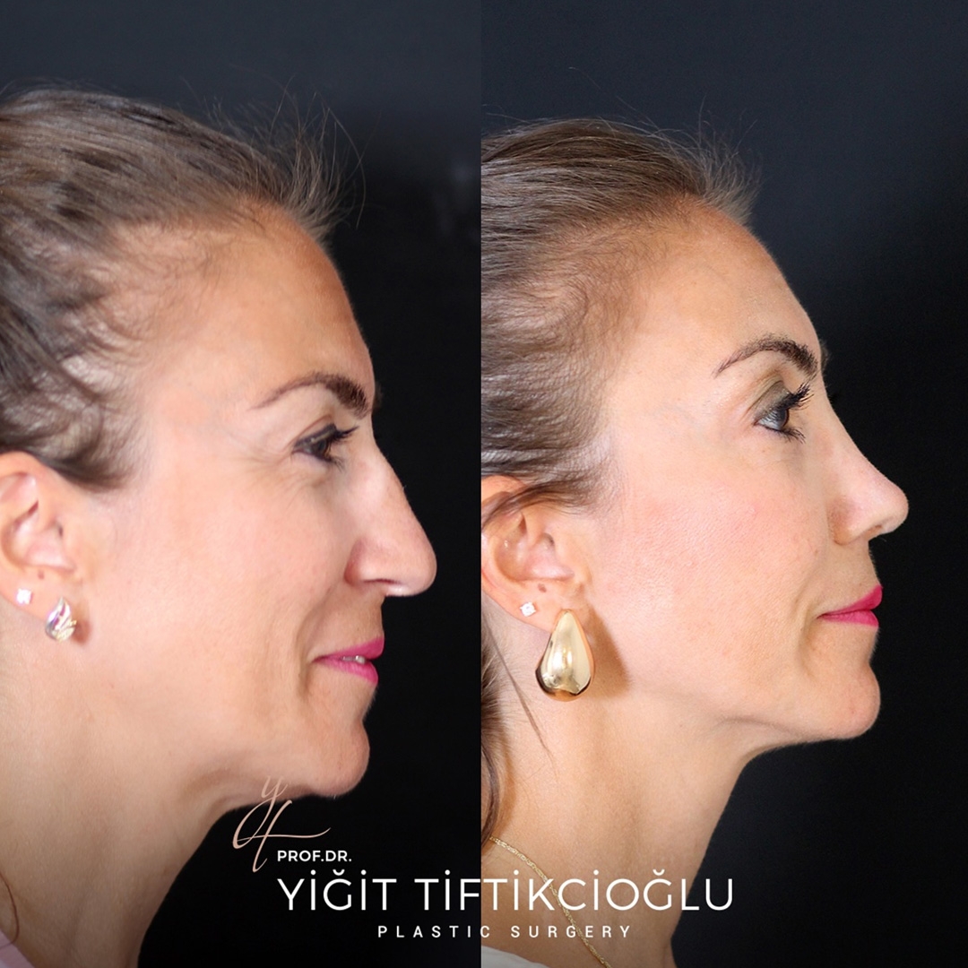 Rhinoplasty Turkey (Nose Job) Before / After